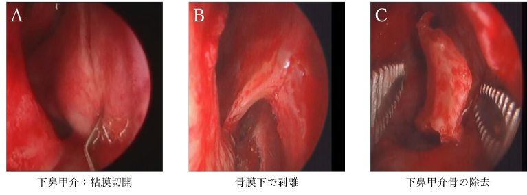 粘膜下下甲介骨切除術