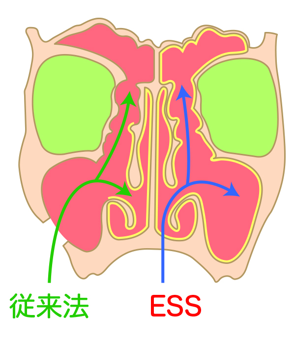 内視鏡下副鼻腔手術（ESS）とは