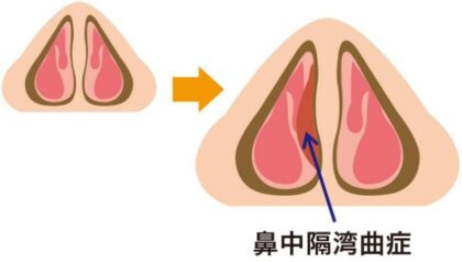 鼻中隔湾曲症とは