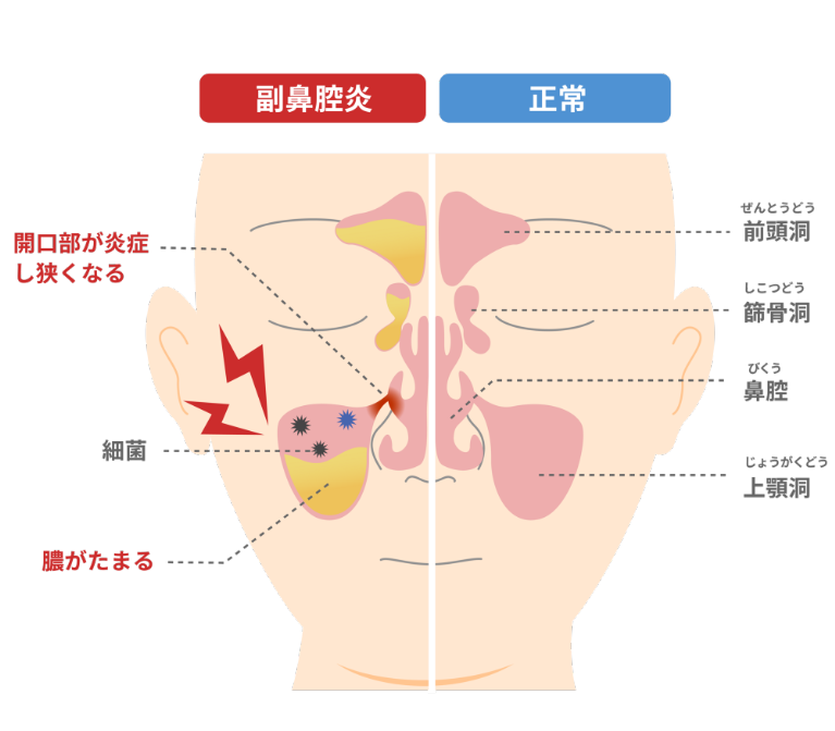 副鼻腔炎