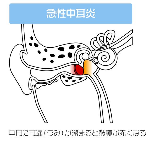 急性中耳炎