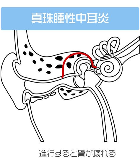 真珠種性中耳炎