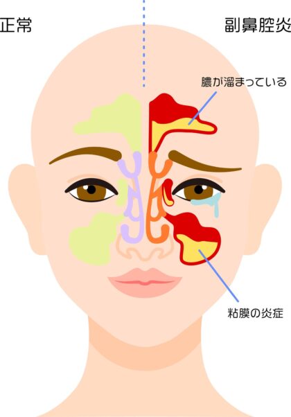 副鼻腔炎（蓄膿症）